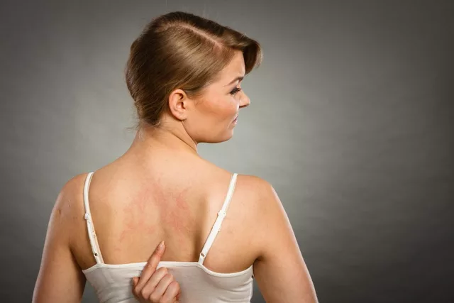 Understanding Hives: Causes, Symptoms, and Treatments
